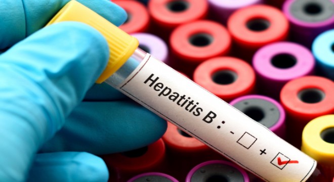 Hepatit hastalığı, yemek borusu varisi için risk oluşturuyor